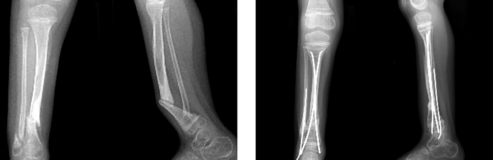 На Камчатке отец-псих сломал сыну ногу