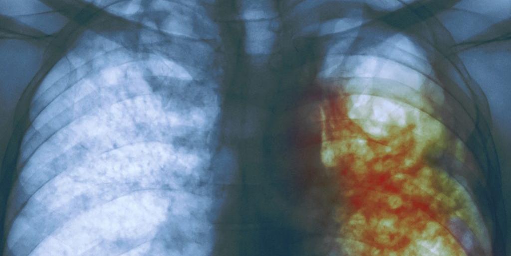 На Камчатке больных туберкулезом отправляли на рентген в обычную больницу
