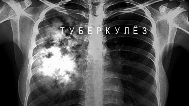 На Камчатке снизилась заболеваемость туберкулезом